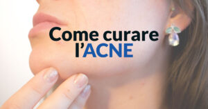 Come curare l'acne - Dermatologo Specialista