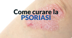 Come curare la psoriasi - Dott. Stefano Veglio